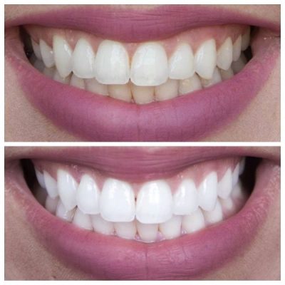 Unique Smile професионален сет за белење заби